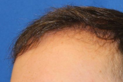 Hair Restoration Before & After Patient #5859