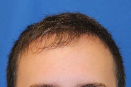 Hair Restoration Before & After Patient #5859