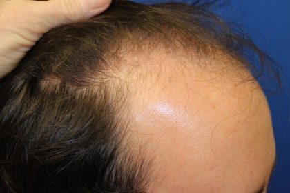 Hair Restoration Before & After Patient #5859