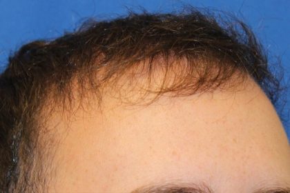 Hair Restoration Before & After Patient #5859