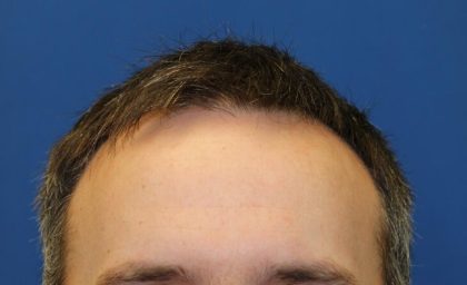 Hair Restoration Before & After Patient #5838