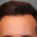 Hair Restoration Before & After Patient #5838