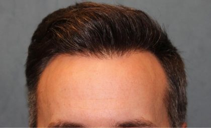 Hair Restoration Before & After Patient #5838