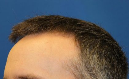 Hair Restoration Before & After Patient #5838