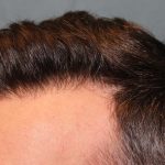 Hair Restoration Before & After Patient #5838