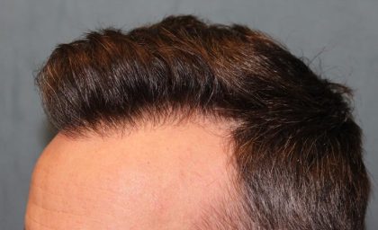 Hair Restoration Before & After Patient #5838