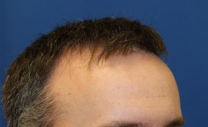 Hair Restoration Before & After Patient #5838