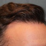 Hair Restoration Before & After Patient #5838