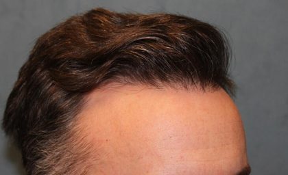 Hair Restoration Before & After Patient #5838