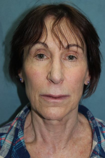 Facelift Before & After Patient #5922