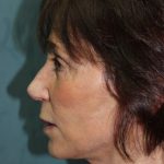 Facelift Before & After Patient #5922