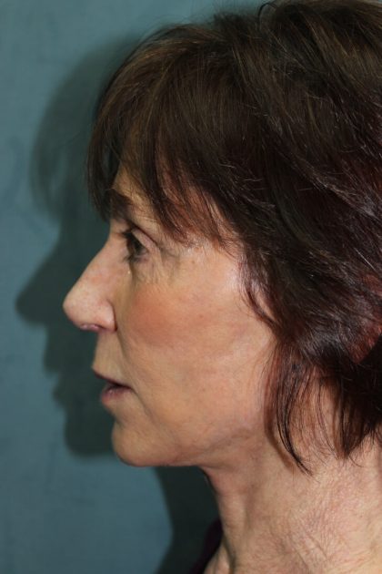 Facelift Before & After Patient #5922