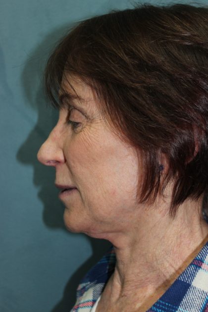 Facelift Before & After Patient #5922