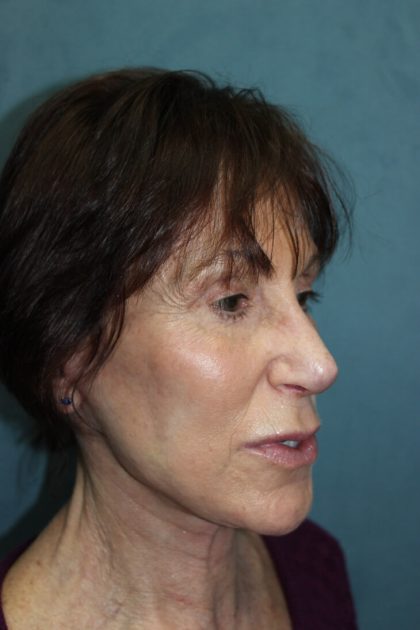 Facelift Before & After Patient #5922