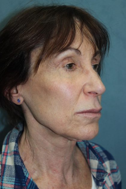 Facelift Before & After Patient #5922