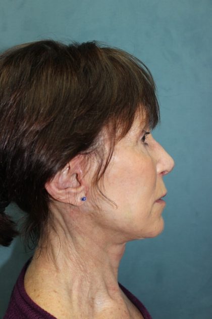 Facelift Before & After Patient #5922