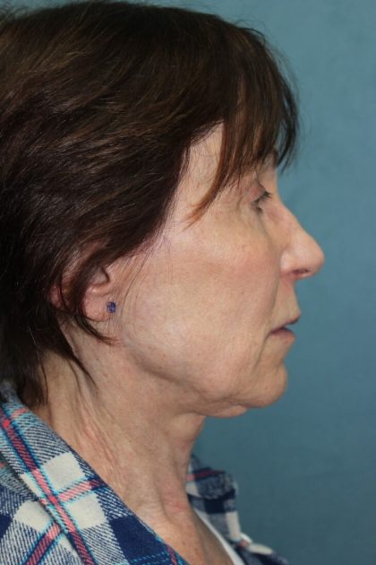 Facelift Before & After Patient #5922