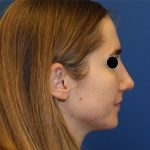 Rhinoplasty Before & After Patient #5969