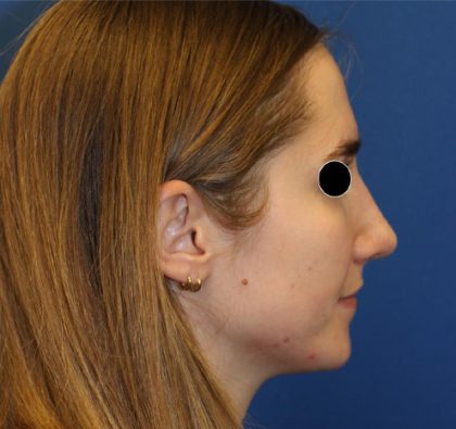 Rhinoplasty Before & After Patient #5969