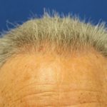 Hair Restoration Before & After Patient #6039