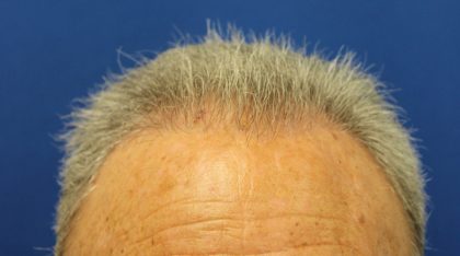 Hair Restoration Before & After Patient #6039