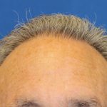 Hair Restoration Before & After Patient #6039