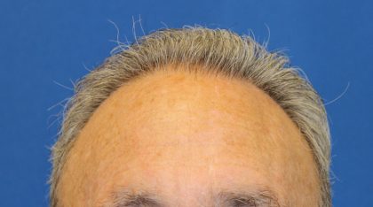 Hair Restoration Before & After Patient #6039