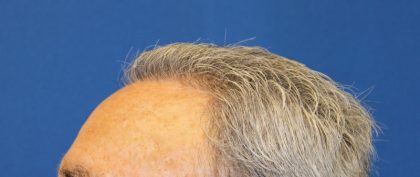 Hair Restoration Before & After Patient #6039