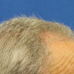 Hair Restoration Before & After Patient #6039