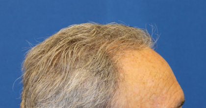 Hair Restoration Before & After Patient #6039