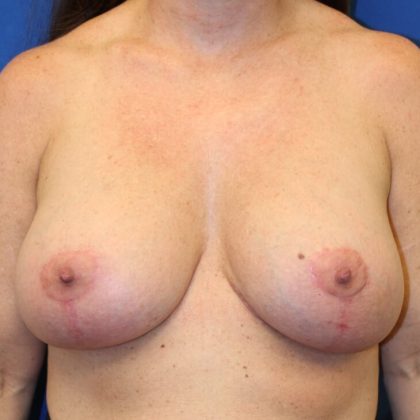 Breast Augmentation Before & After Patient #6019
