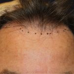 Hair Restoration Before & After Patient #6060