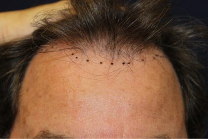 Hair Restoration Before & After Patient #6060