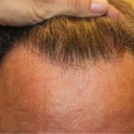 Hair Restoration Before & After Patient #6060