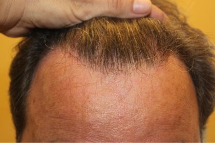 Hair Restoration Before & After Patient #6060