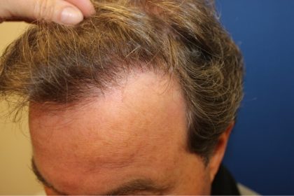 Hair Restoration Before & After Patient #6060