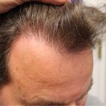 Hair Restoration Before & After Patient #6060