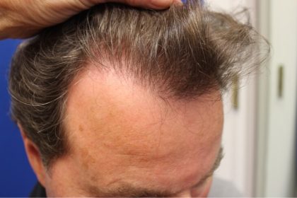 Hair Restoration Before & After Patient #6060