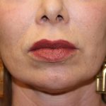 Lip Lift Before & After Patient #6100