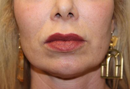 Lip Lift Before & After Patient #6100