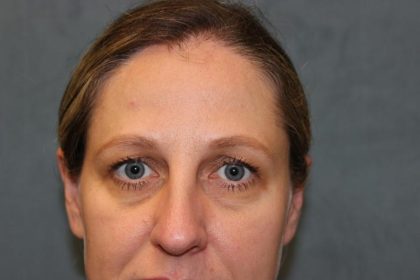 Laser Assisted Blepharoplasty Before & After Patient #6059