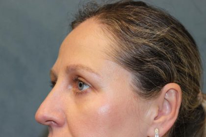 Laser Assisted Blepharoplasty Before & After Patient #6059