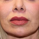 Lip Lift Before & After Patient #6100