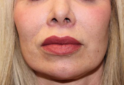 Lip Lift Before & After Patient #6100