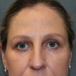 Laser Assisted Blepharoplasty Before & After Patient #6059