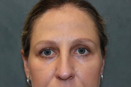 Laser Assisted Blepharoplasty Before & After Patient #6059