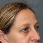 Laser Assisted Blepharoplasty Before & After Patient #6059