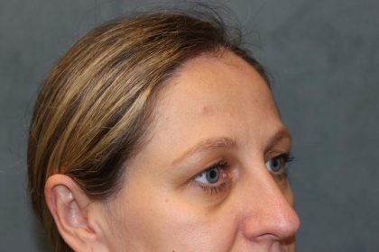 Laser Assisted Blepharoplasty Before & After Patient #6059