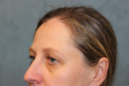 Laser Assisted Blepharoplasty Before & After Patient #6059