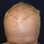 Hair Restoration Before & After Patient #6153